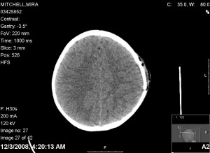 Mira after surgery Mira's cat scan after surgery